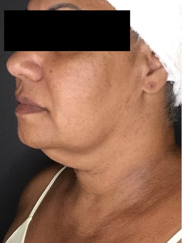 Antes — lipoaspiração de papada