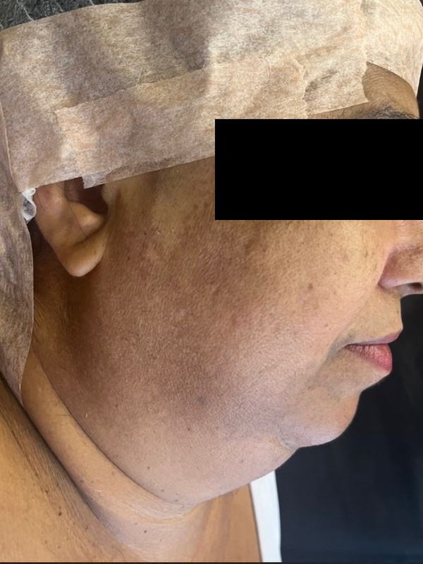 Antes — lipoaspiração de papada