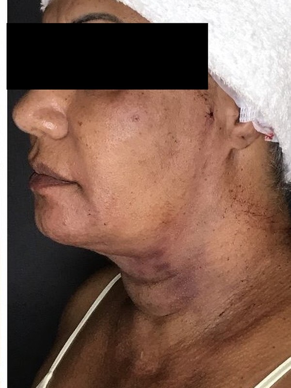 Depois — lipoaspiração de papada