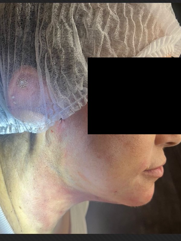 Depois — lipoaspiração de papada