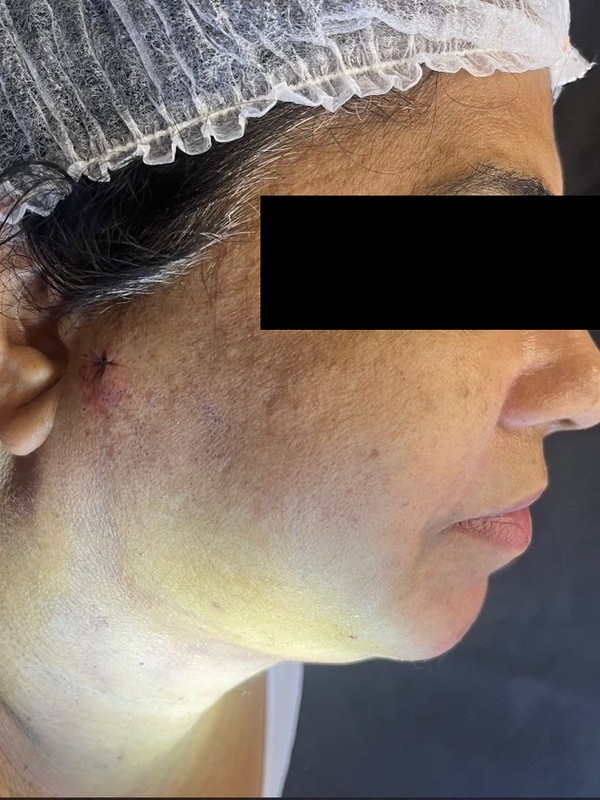 Depois — lipoaspiração de papada